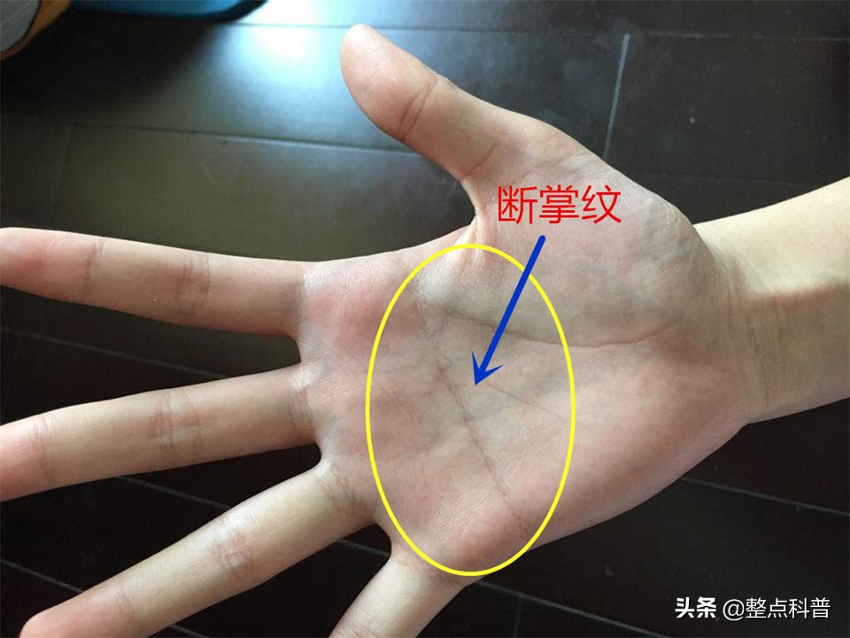 民间断掌纹说法,断掌纹与先天疾病