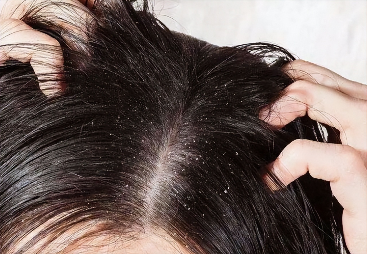 头皮上经常长脓包和疙瘩,是怎么回事?医生:或和这3种问题有关