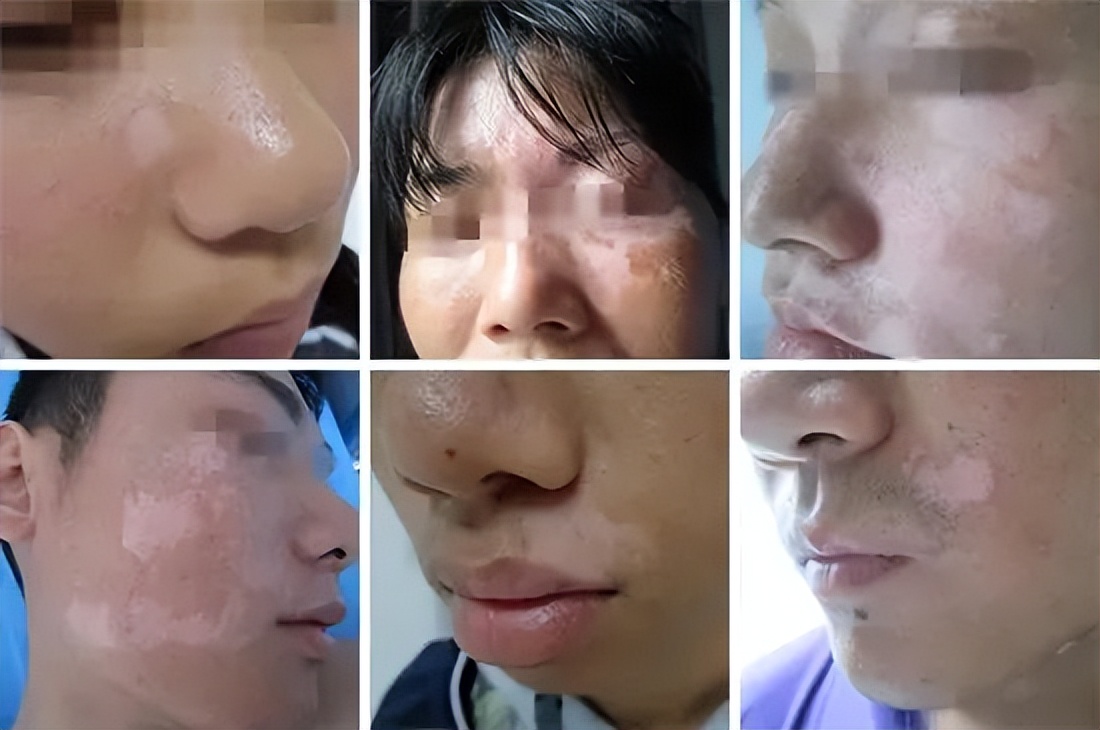 他克莫司怎么这么多副作用,他克莫司不要轻易用