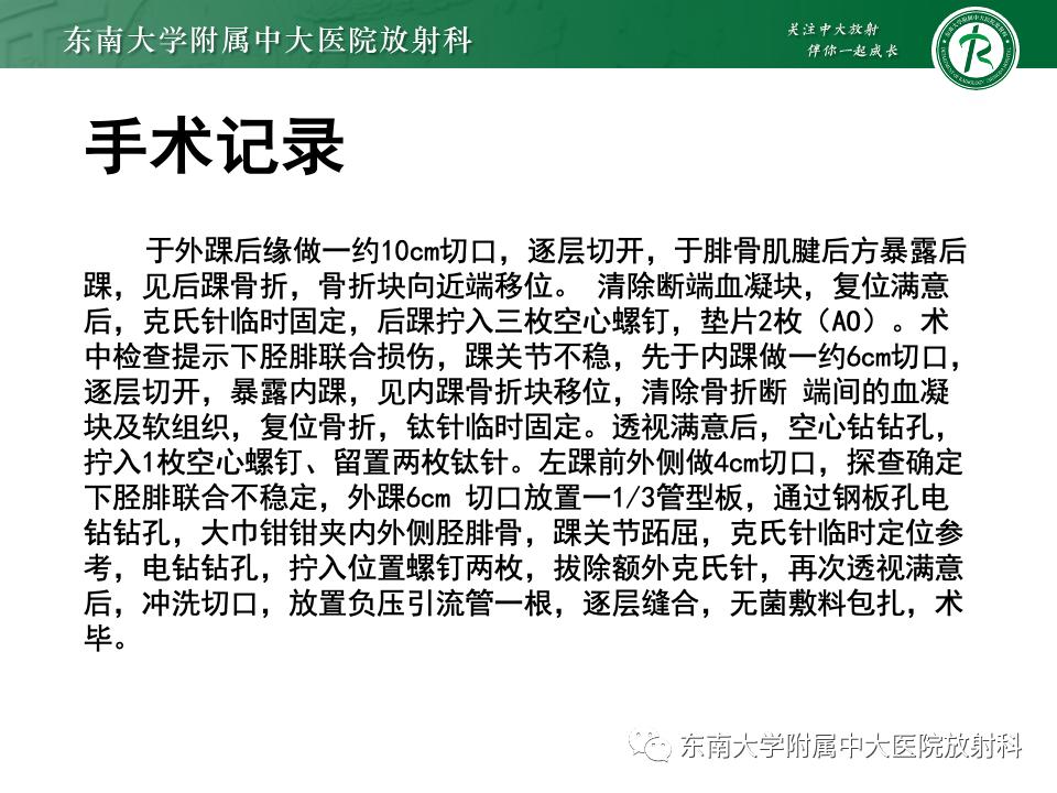 左腓骨下段骨折伴下胫腓联合分离,好文分享深度揭秘