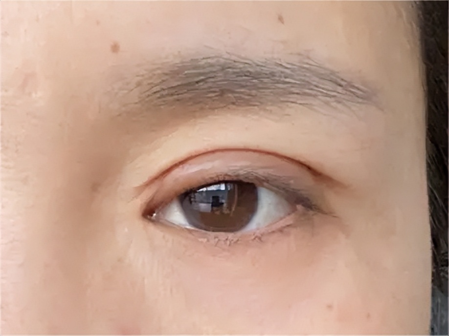 双眼皮术后眼头紧绷有细纹,双眼皮术后很多疤痕怎么办