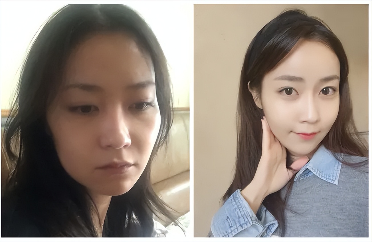 面部填充失败案例,脂肪填充面部失败案例