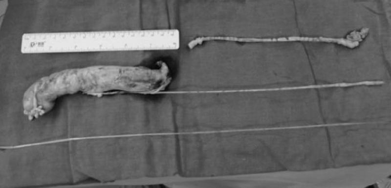 子宫肌瘤罕见,罕见子宫肌瘤半年疯长到20公分