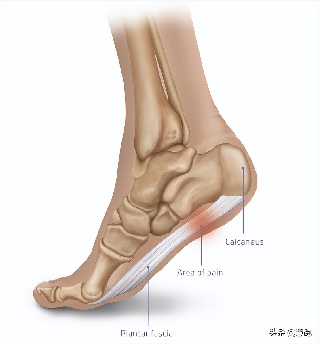 足底筋膜炎久治不愈怎么办,为什么足筋膜炎久治不愈