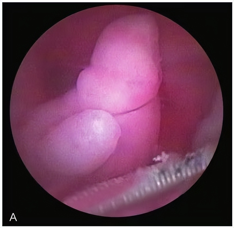 妇科医生5分钟小科普,门诊宫腔镜科普文章