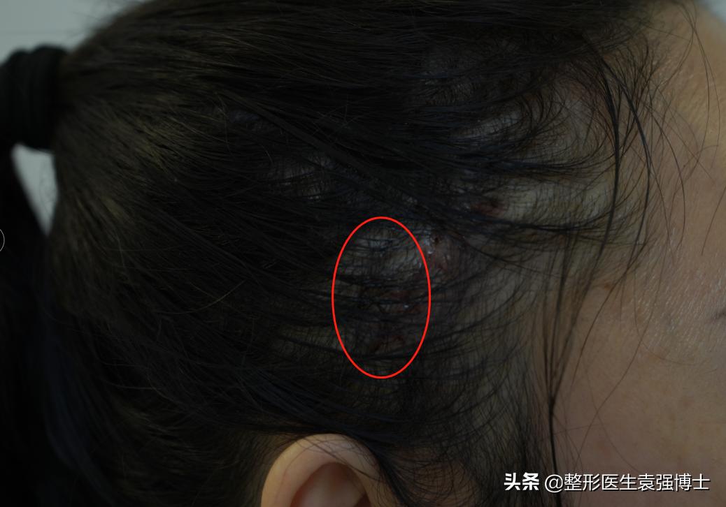 拉皮变美逆龄抗衰,拉皮逆龄抗衰