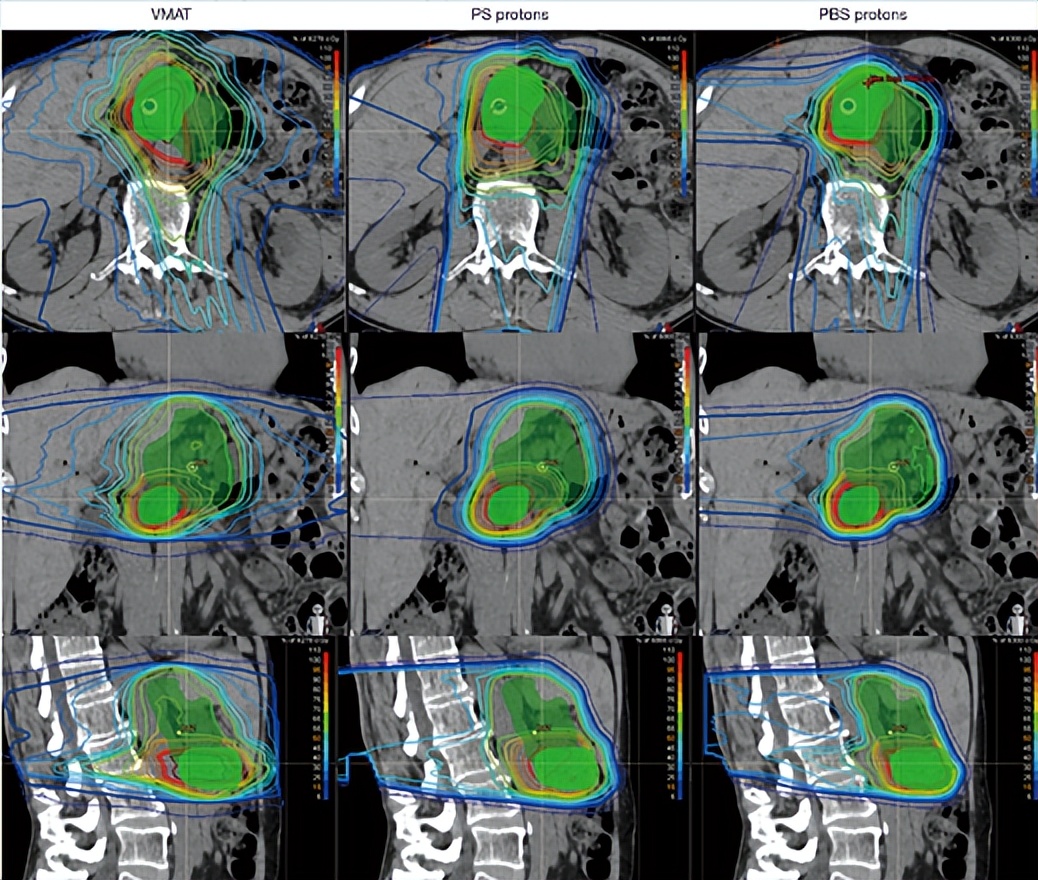 日本胰腺癌生存率多少,日本胰腺癌5年存活率