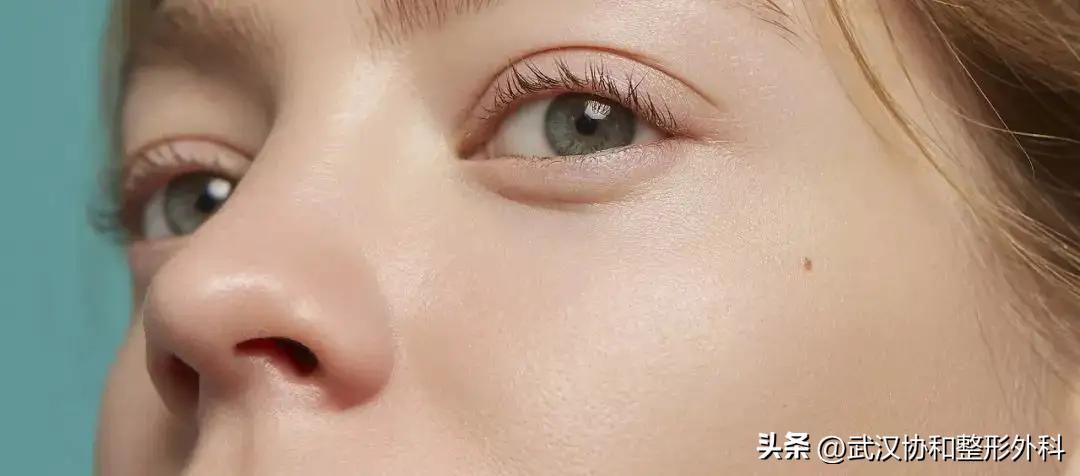 平行双眼皮手术图片,埋线双眼皮手术价格