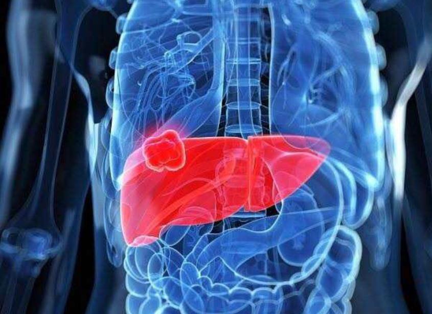 老中医治肝癌的3大征兆,中医治疗肝癌的最新方法