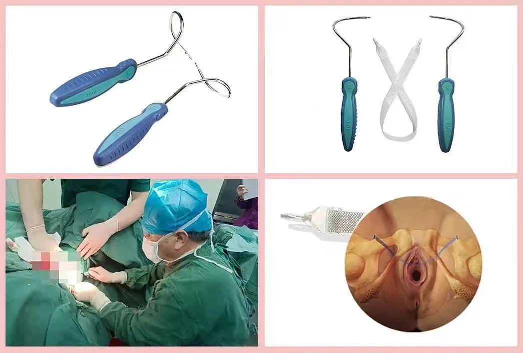 尿失禁漏尿做手术怎么做,女性尿失禁长期漏尿怎么办