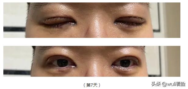 男生割双眼皮的意思,男生眼睛小割双眼皮会好看吗