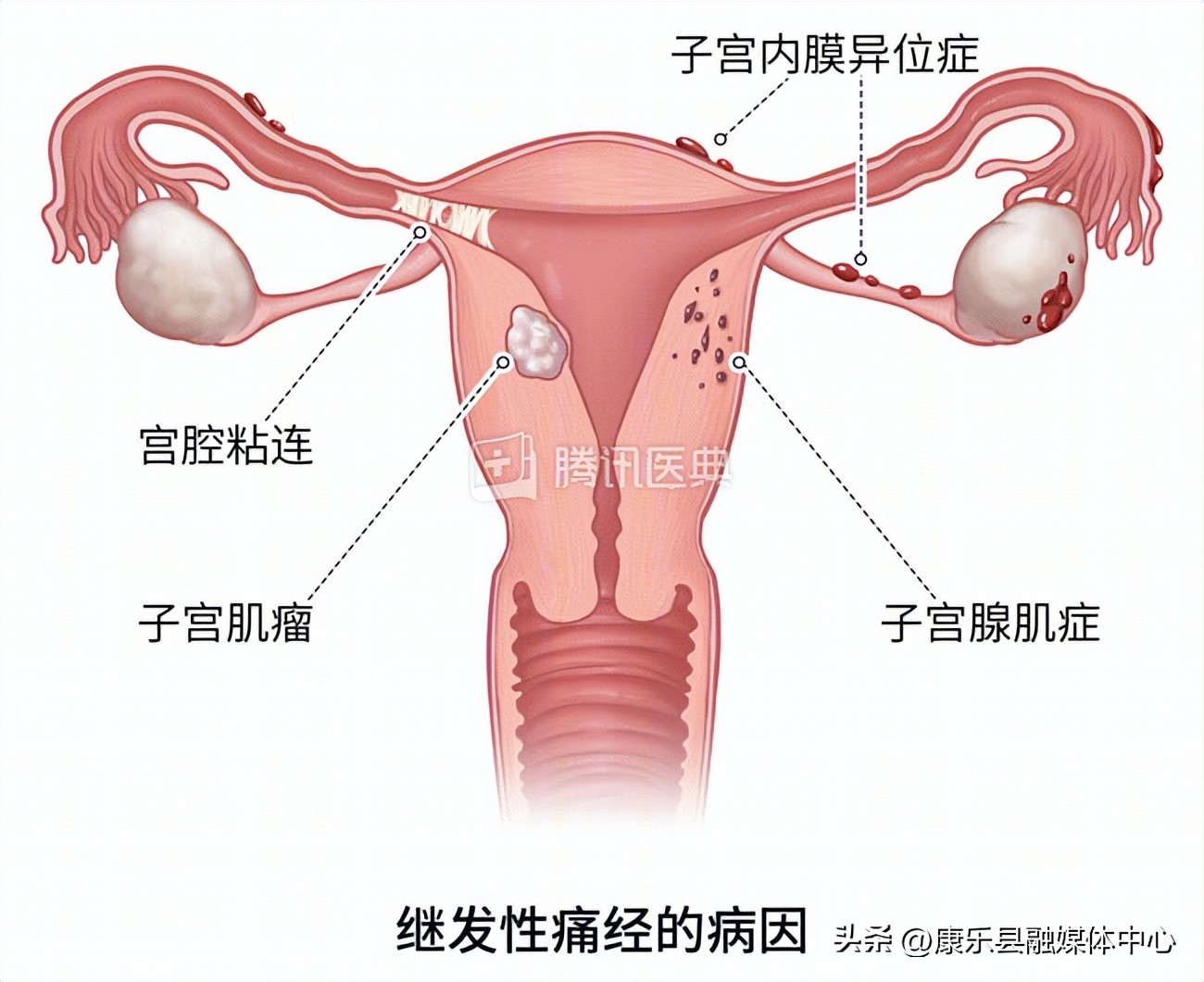 痛经喝咖啡能止痛吗,经期喝咖啡会加重痛经吗