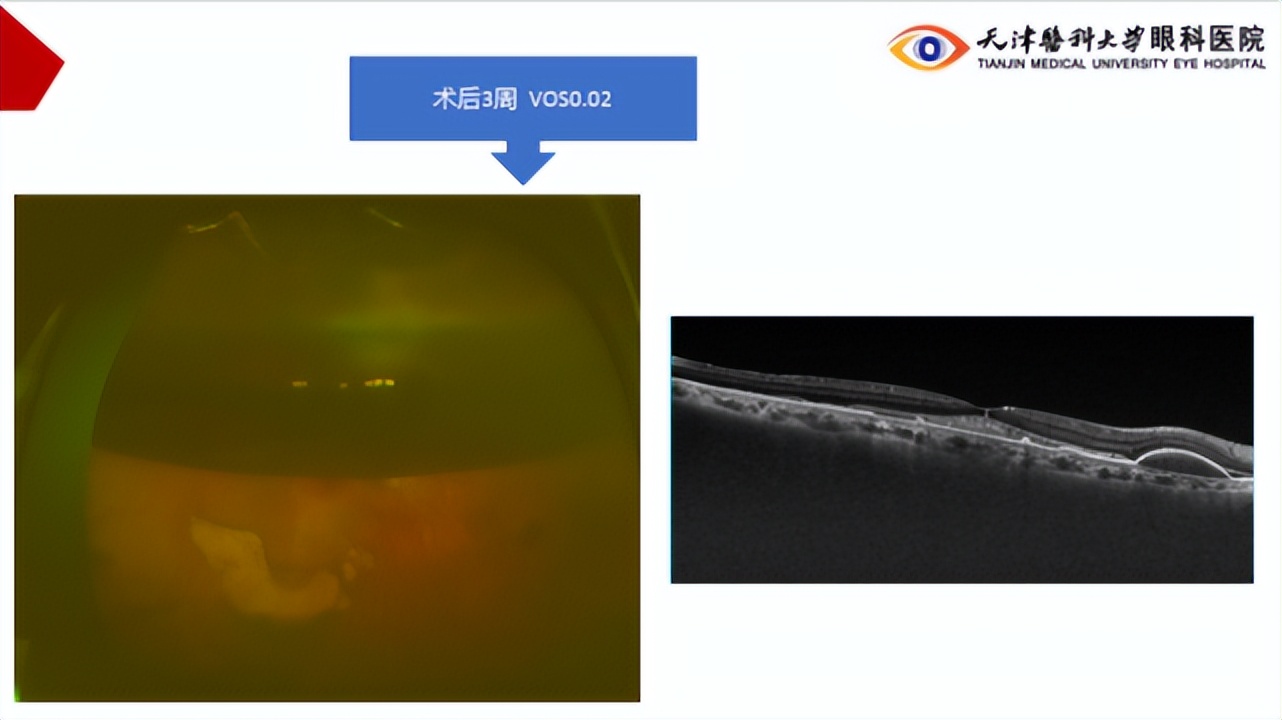 李筱荣教授,天津医科大学眼科医院李筱荣