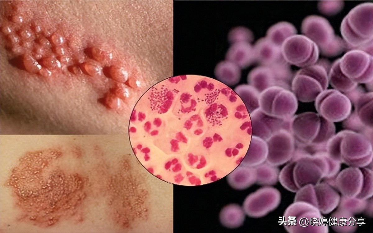 不能治愈的性传播疾病,考虑性传播疾病诊断