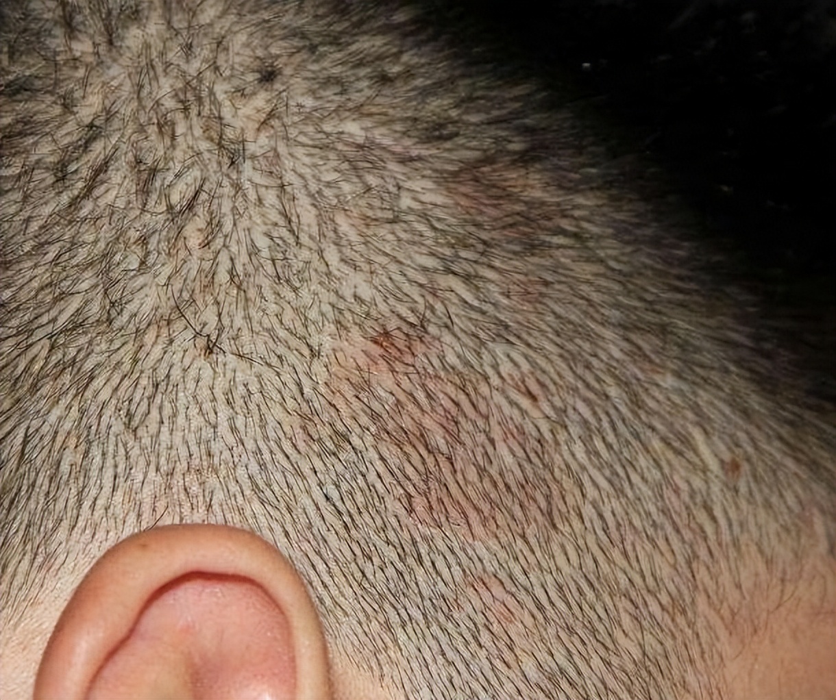 头上起疙瘩有脓包还掉发什么原因,老人头上总是起脓包疙瘩