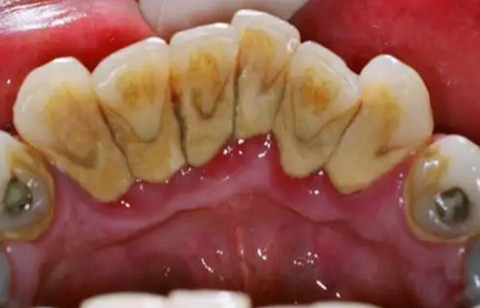 教你们一招去除牙结石,牙结石刷牙就掉了怎么办