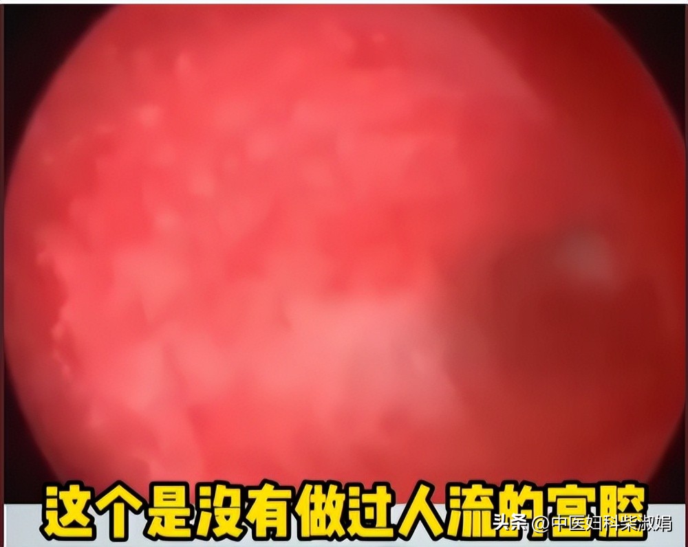 一组图，揭秘人流后的子宫状态，结果太直观了