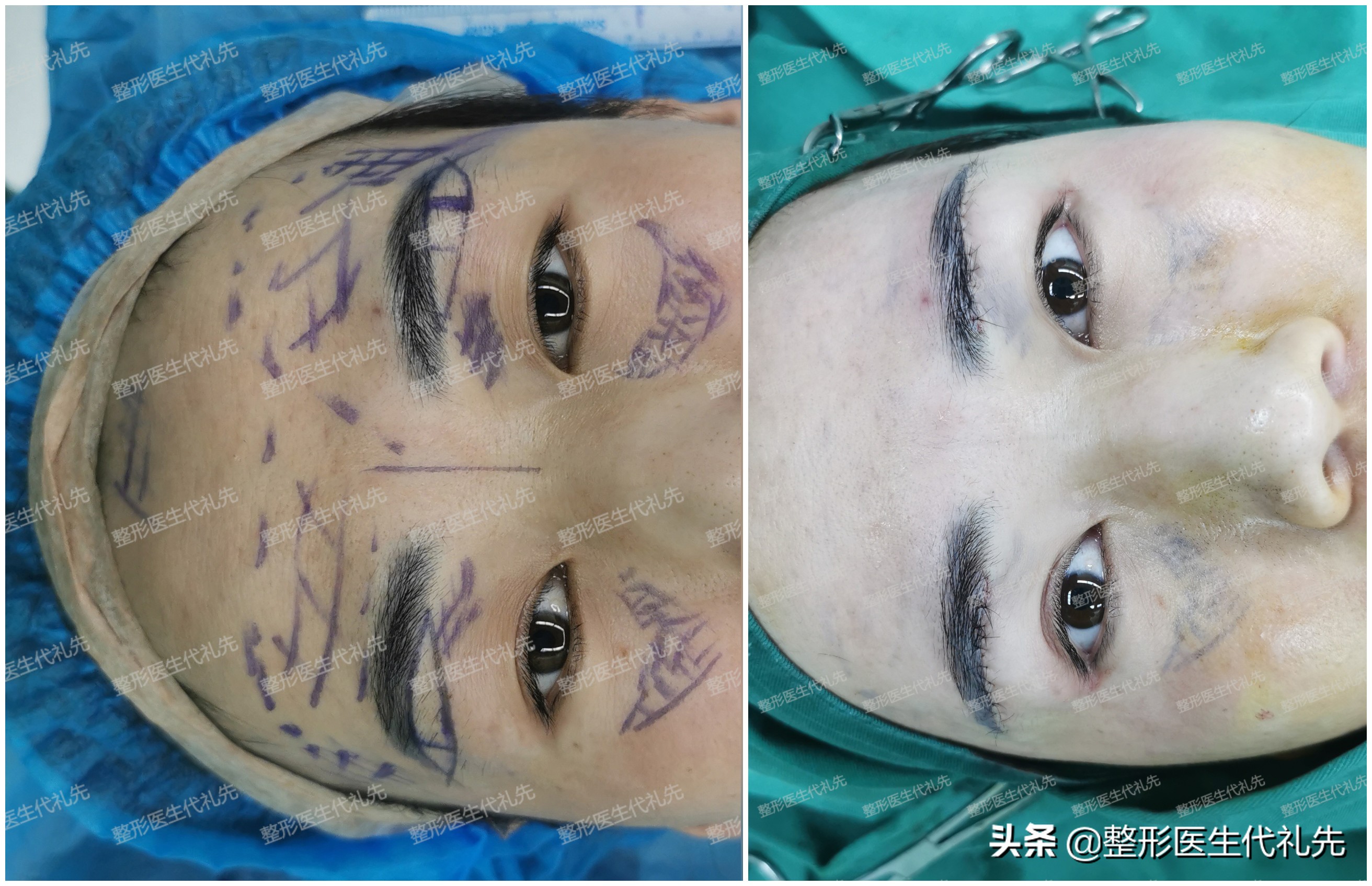 做眼袋的内切和外切的利弊,外切眼袋与内切眼袋的鉴定