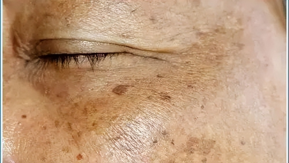 什么药可以去老年斑最有效,老人斑用什么药膏擦最有效