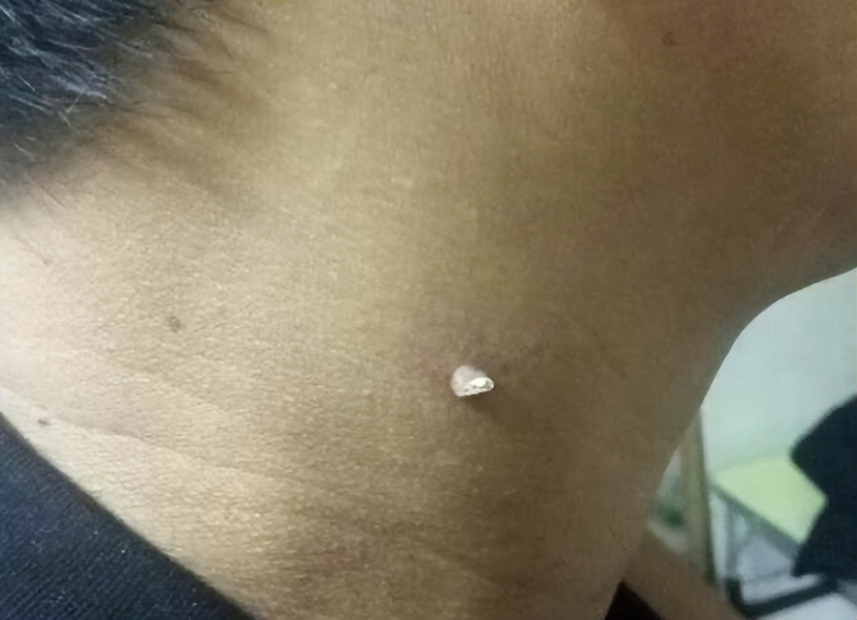 脖子上肉粒可以自己揪掉么,脖子腋下长小肉粒可以用手揪掉吗