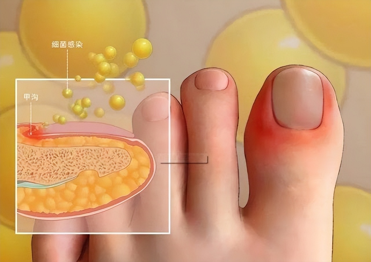 脚趾甲往肉里面长很疼算甲沟炎吗,脚趾甲老往肉里钻一碰还疼