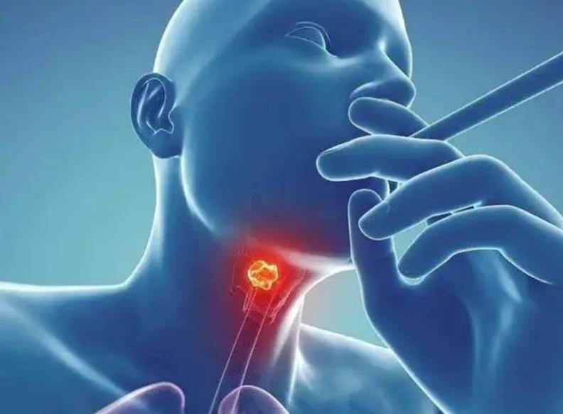 喉癌的症状患者自述,喉癌患者的自述