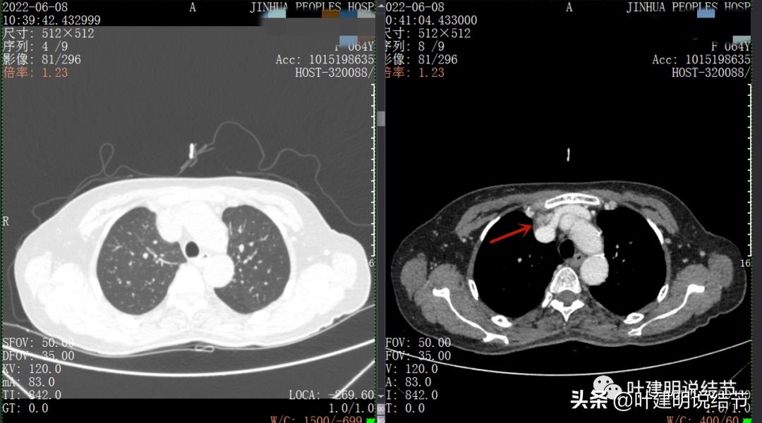 这位老乡，乏力来查，查出这么大个的纵隔肿瘤！会是什么呢？