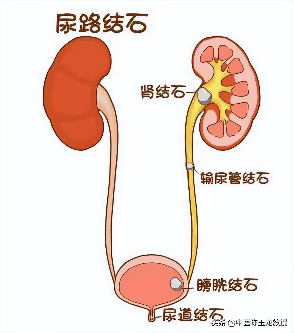 中医治疗膀胱结石经典处方,治疗胆结石肾结石膀胱结石的方子