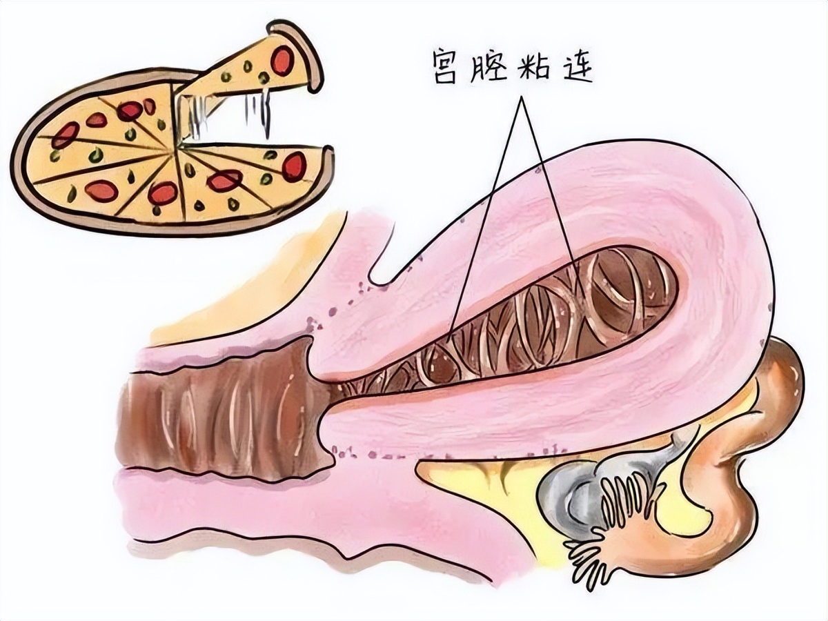 人流后宫腔粘连会导致不孕吗,宫腔粘连原发不孕是什么意思