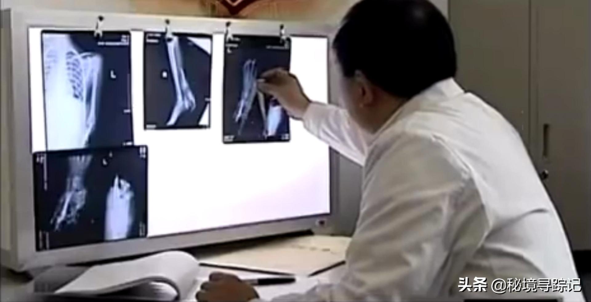 儿童胳膊断了做手术,小孩手臂断了真实手术