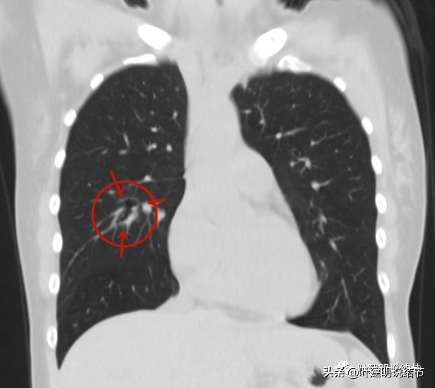 肺内多发囊腔样病灶是什么病,肺部囊腔样病灶可怕吗