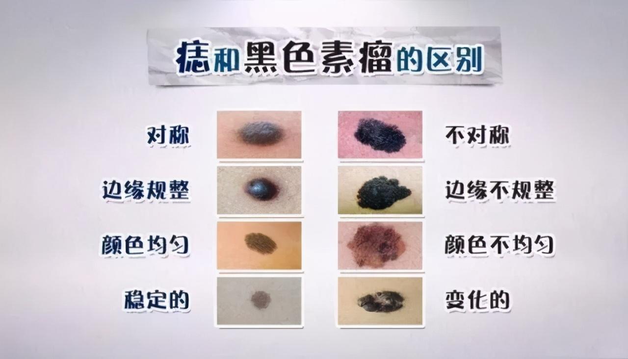 黑痣和黑色素瘤哪种易癌变,37岁歌手因为黑色素瘤去世