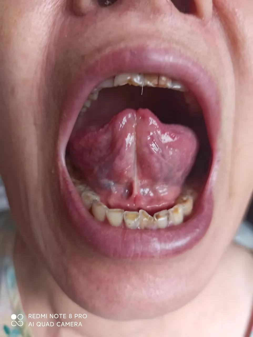 干燥综合征吃中药多久可以控制,干燥综合征喝中药可以治愈吗