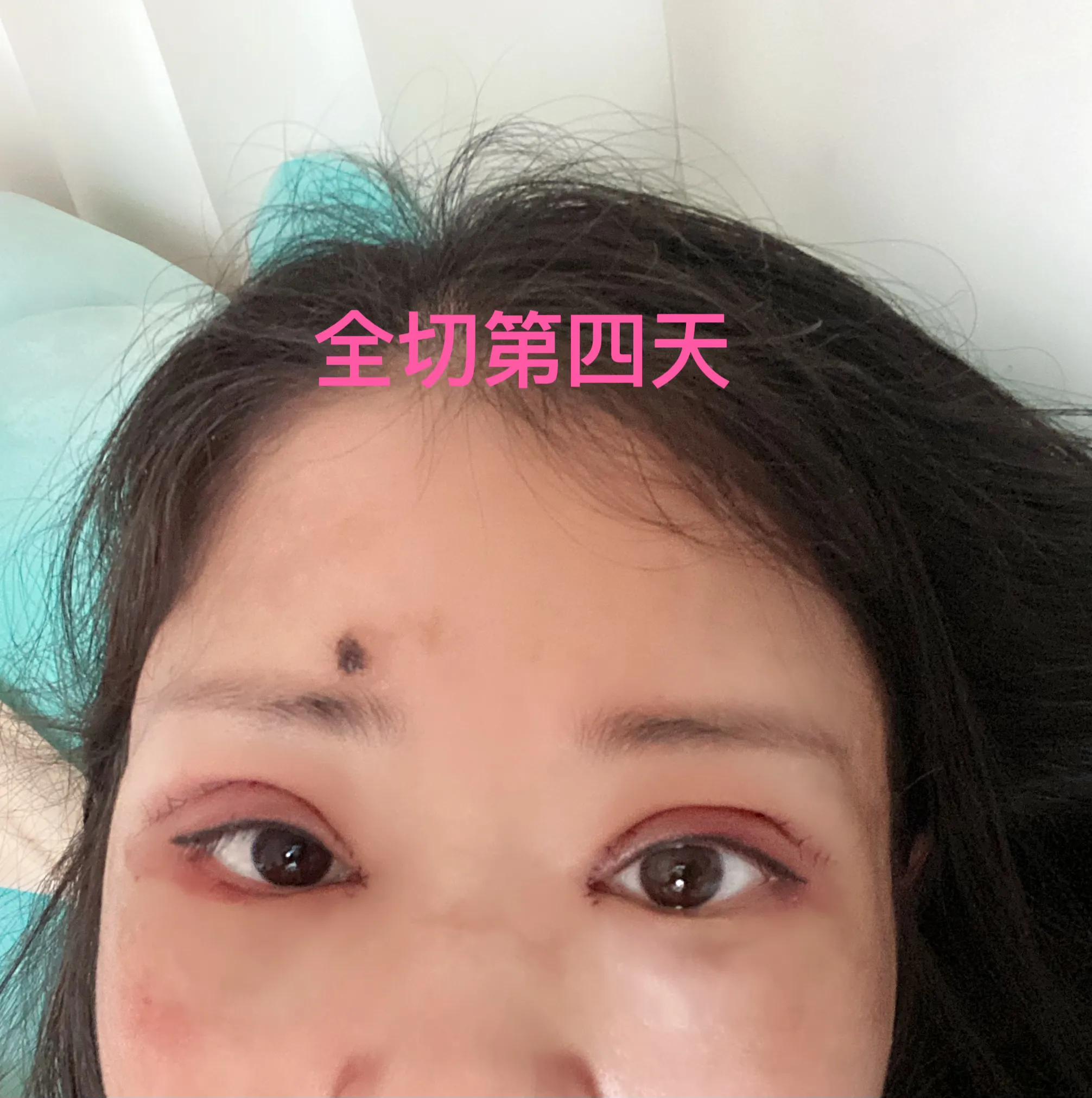 做双眼皮恢复期间能吃红糖吗,恢复最快的双眼皮