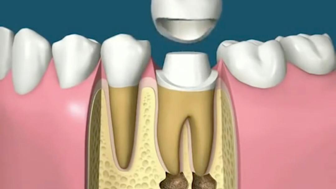 牙齿掉了一块怎么办？需要拔牙吗？