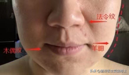 40岁面部皮肤松弛怎么紧致,40岁脸部松弛锻炼可以改善吗