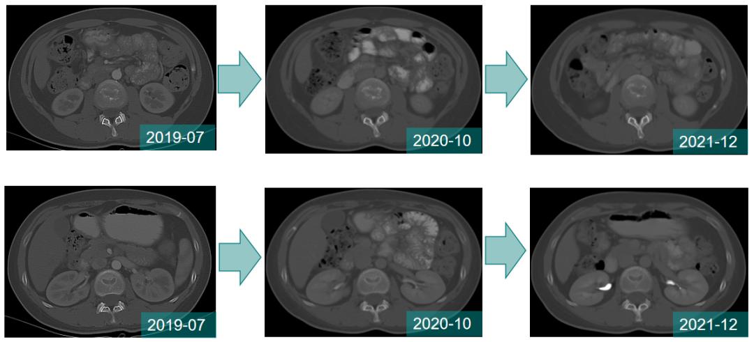 曲妥珠单抗副作用几天消失,曲妥珠单抗联合帕妥珠单抗