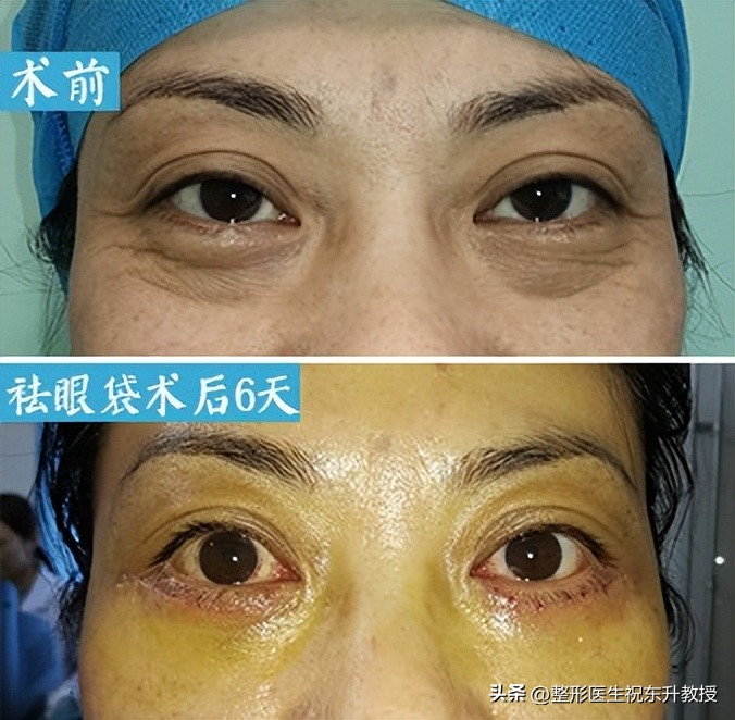 做过眼袋手术的视频,做眼袋经验足的医生