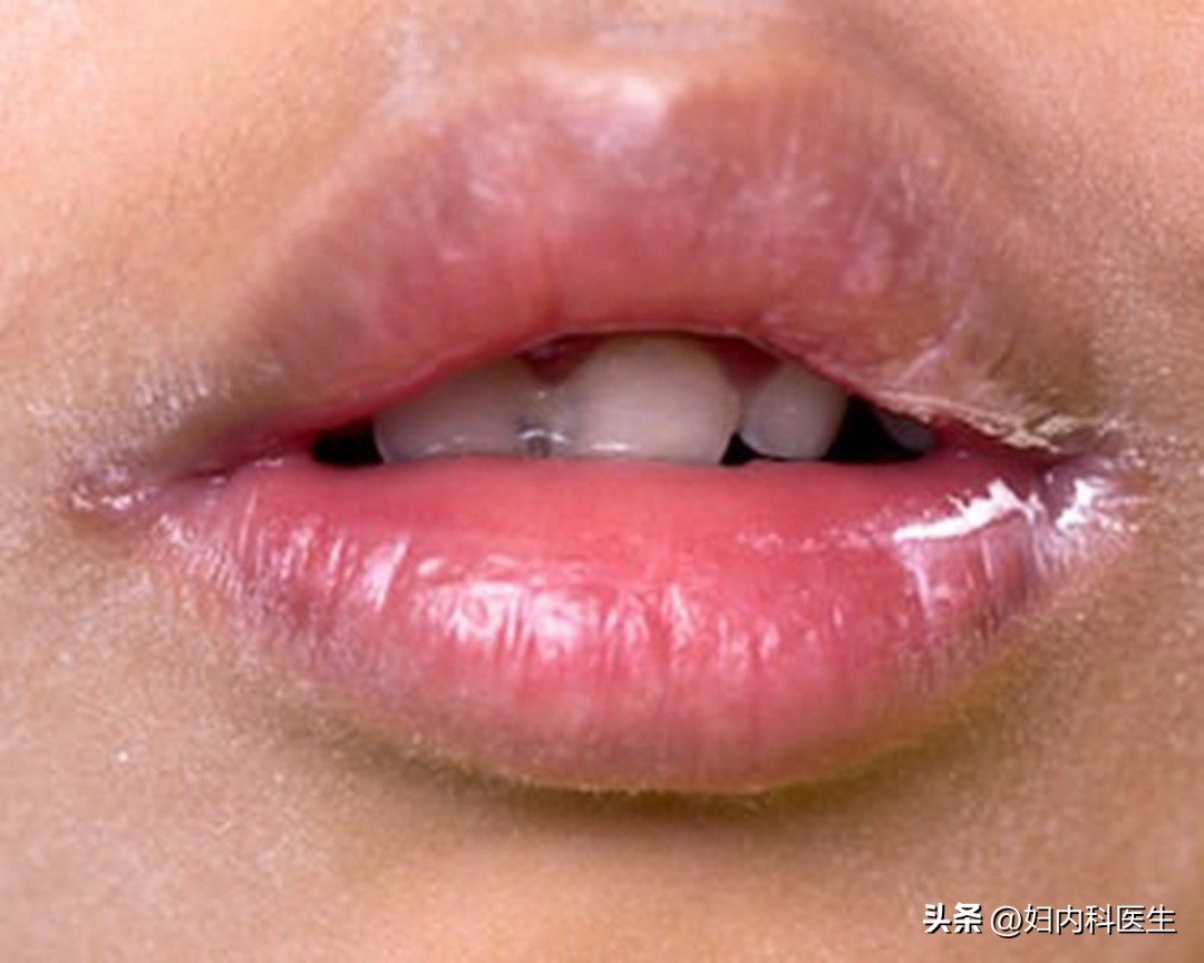 2元钱的红霉素软膏能治疗什么病,2元一支的红霉素功效居然这么多