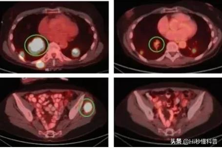 抗癌药有望彻底治愈癌吗,新抗癌药能治愈所有癌症吗