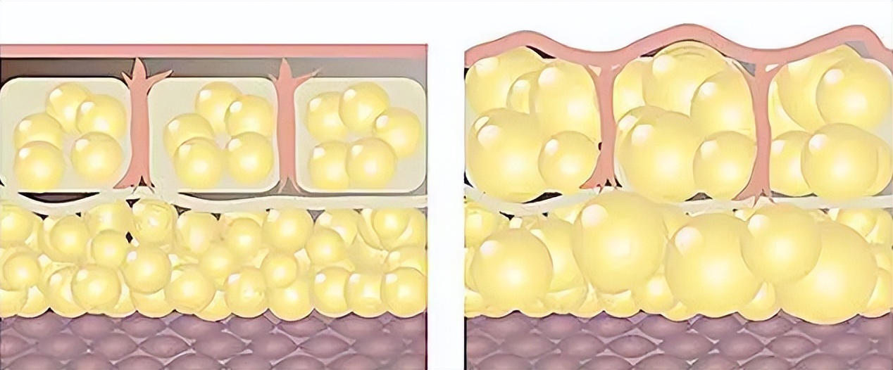 脂肪填面部后的注意事项,脂肪填充后皮肤会不会容易变红