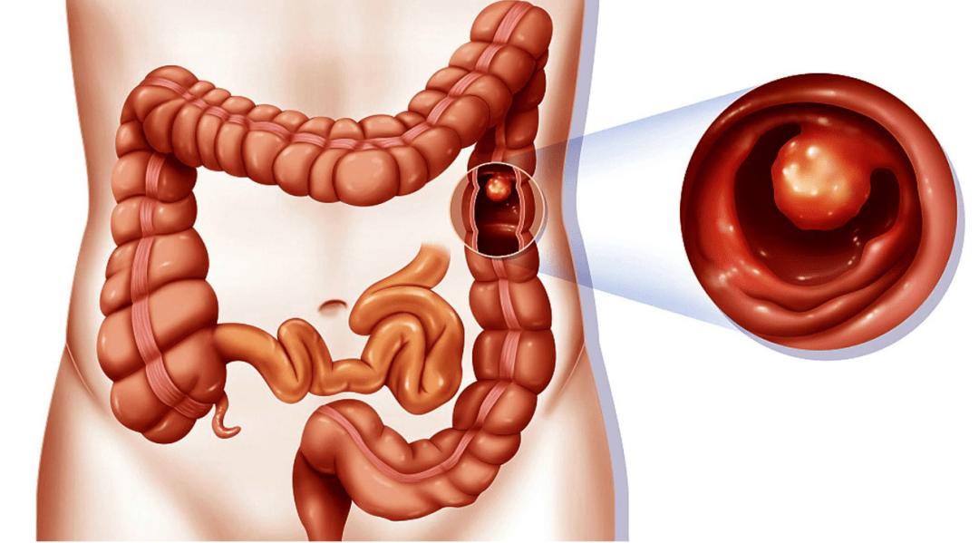 把好饮食“进口”关!松江医生教你应对肛肠疾病|健康智慧屋
