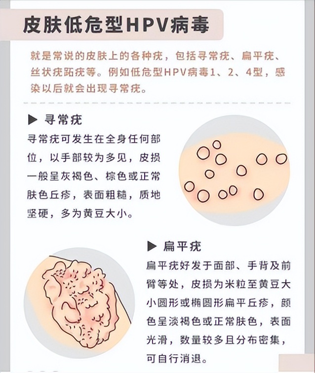 HPV不可忽视的知识点,一篇文章让你了解透彻
