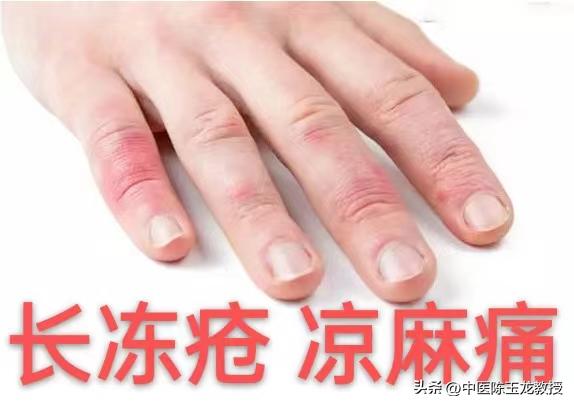 痛经特效方剂,当归四逆汤治冻疮疼痛案例