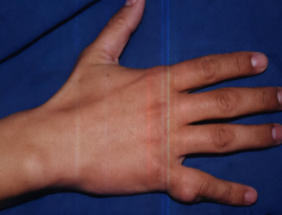 更年期女性手指腱鞘炎,女性绝经易患屈指腱鞘炎吗