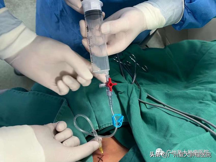 肺结节在内部如何切除,肺气管结节怎么治疗效果最好