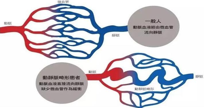 动静脉畸形算重大疾病吗,儿童动静脉畸形介入治疗