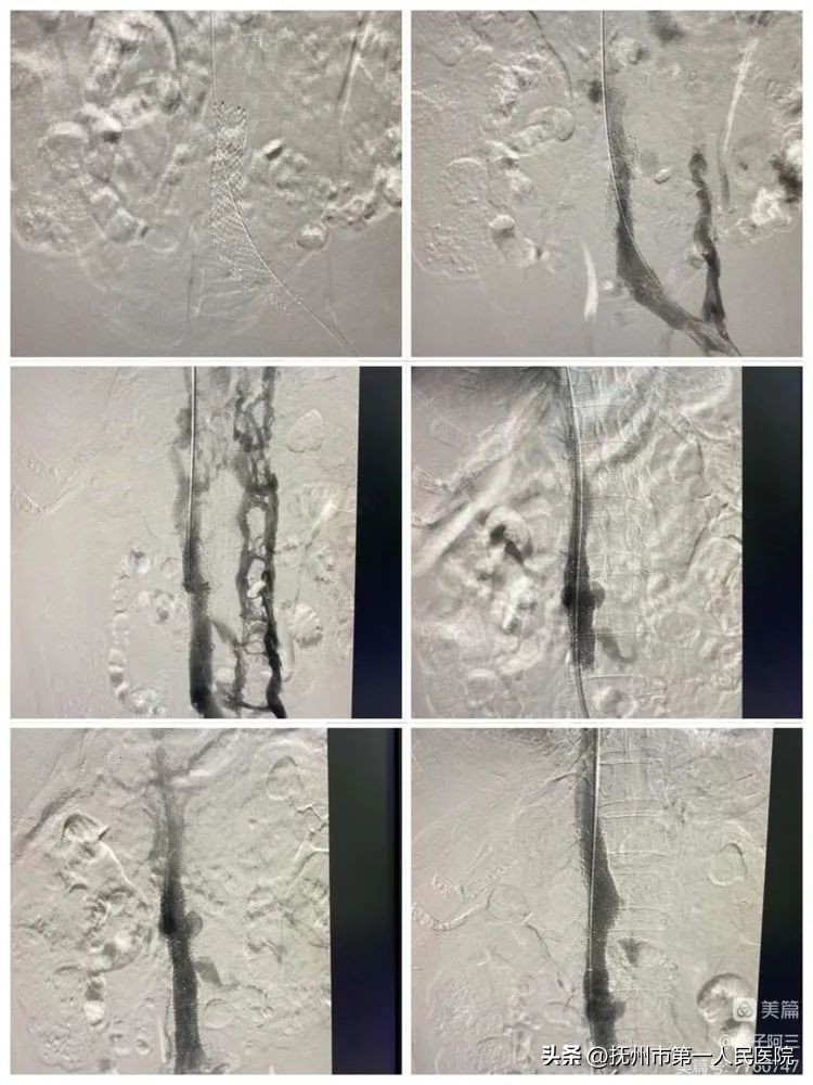 布加氏综合征介入治疗的注意事项,布加综合征介入手术加支架的利弊