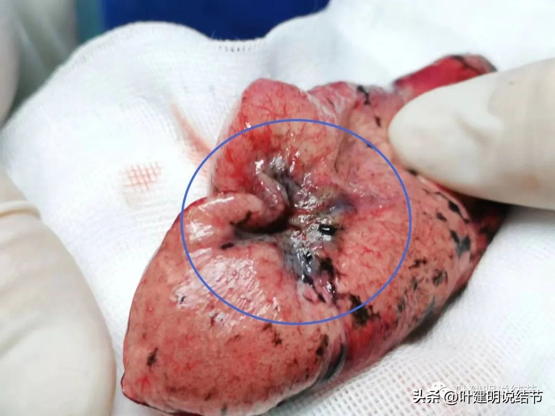 79岁肺癌早期手术风险,75岁早期浸润性肺癌还要治疗吗