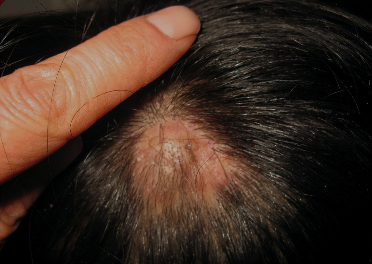 头上起疙瘩有脓包一挤出血,头上长疙瘩有脓包红肿怎么办